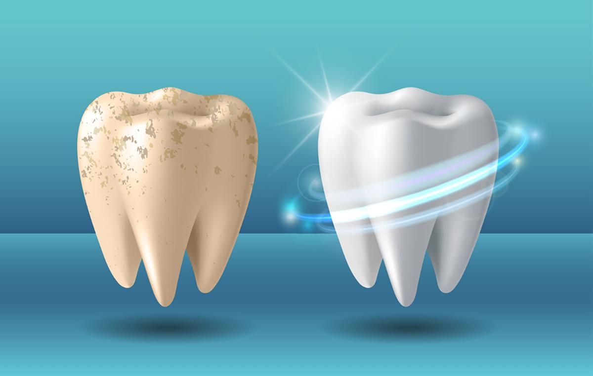 Что происходит с зубами, когда их отбеливают