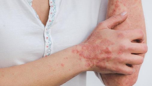 Псоріазом можна заразитись: міфи про шкірне захворювання