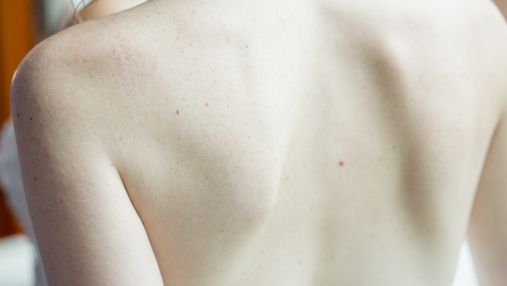 Чому з'являються прищі на спині та як їх лікувати 