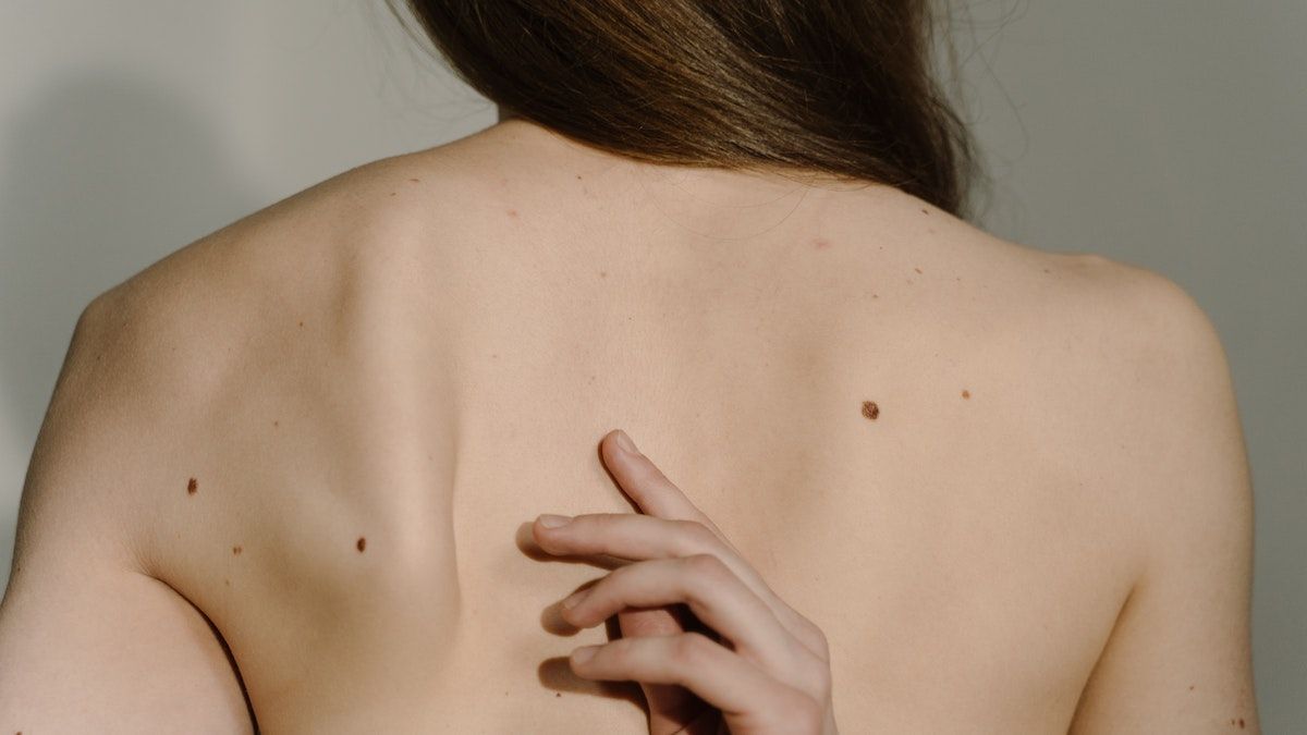 Ознаки хвороби печінки з'являються на шкірі