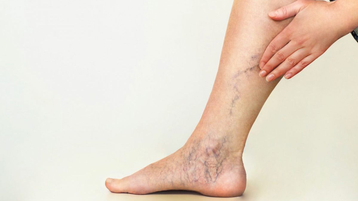 Як запобігти утворенню тромбів у ногах